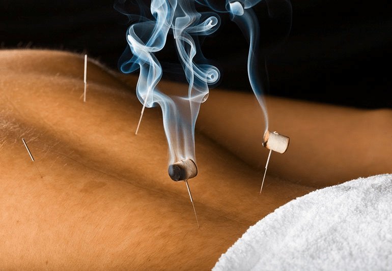 Moxibustion sur aiguille : choisir le bon matériel